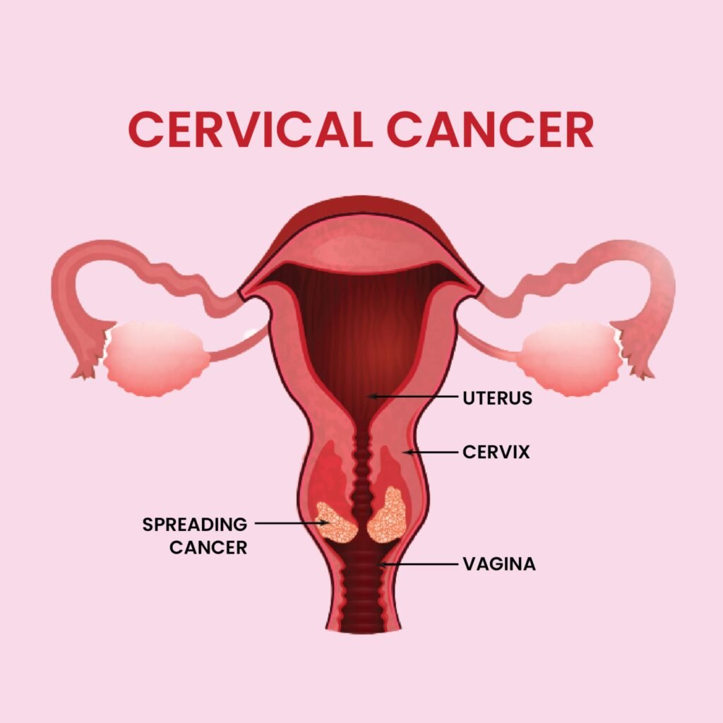 cervical cancer - naari wromens hospital.