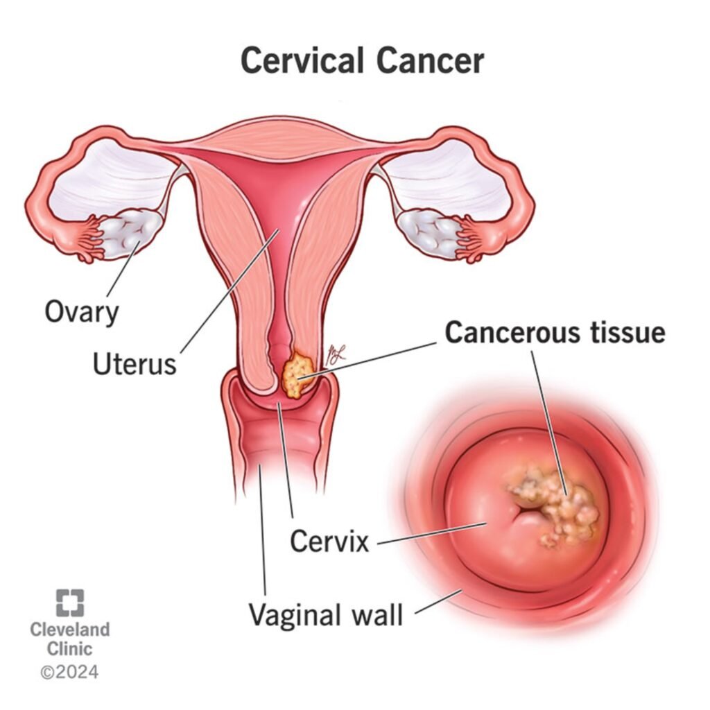 cervical cancer - naari wromens hospital
